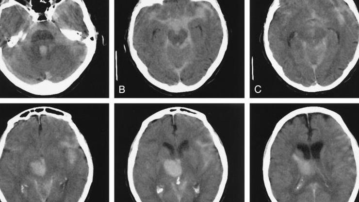 Beyin Kanamas Belirtileri Nelerdir Tedavisi Nas L Olur