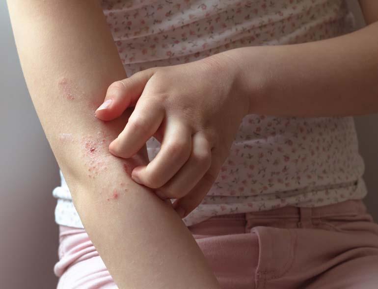 Besin alerjisi her 17 çocuktan birini etkiliyor