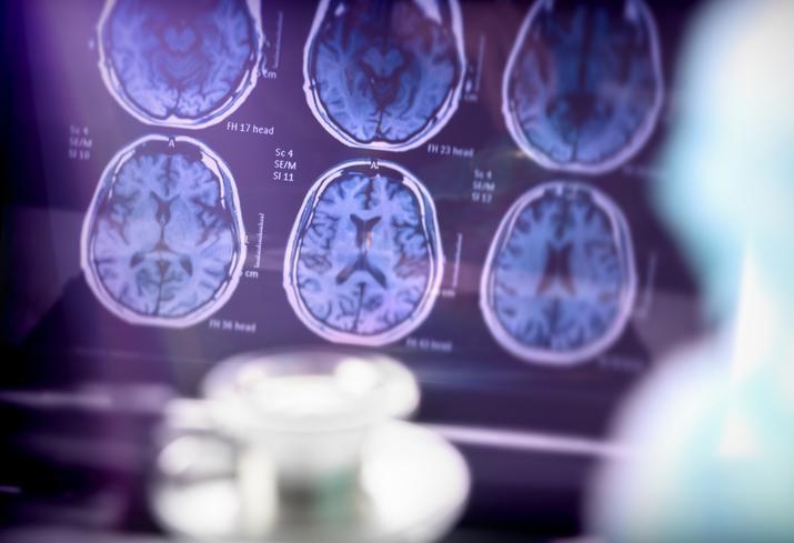 Alzheimer'a kalkan olan o yöntem! Uzman isim açıkladı