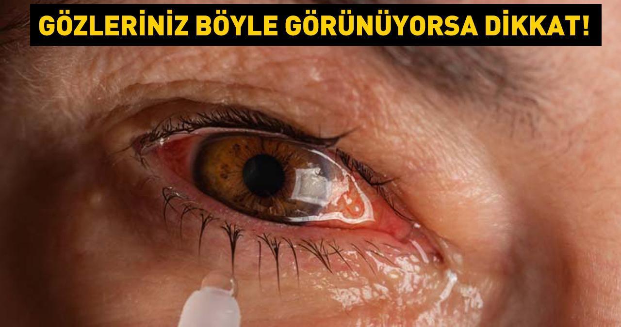 Gözleriniz böyle görünüyorsa dikkat! Çiğ etten bile bulaşabiliyor! 3 kritik belirti ile başlıyor... Tedavi edilmezse görme kaybına yol açıyor