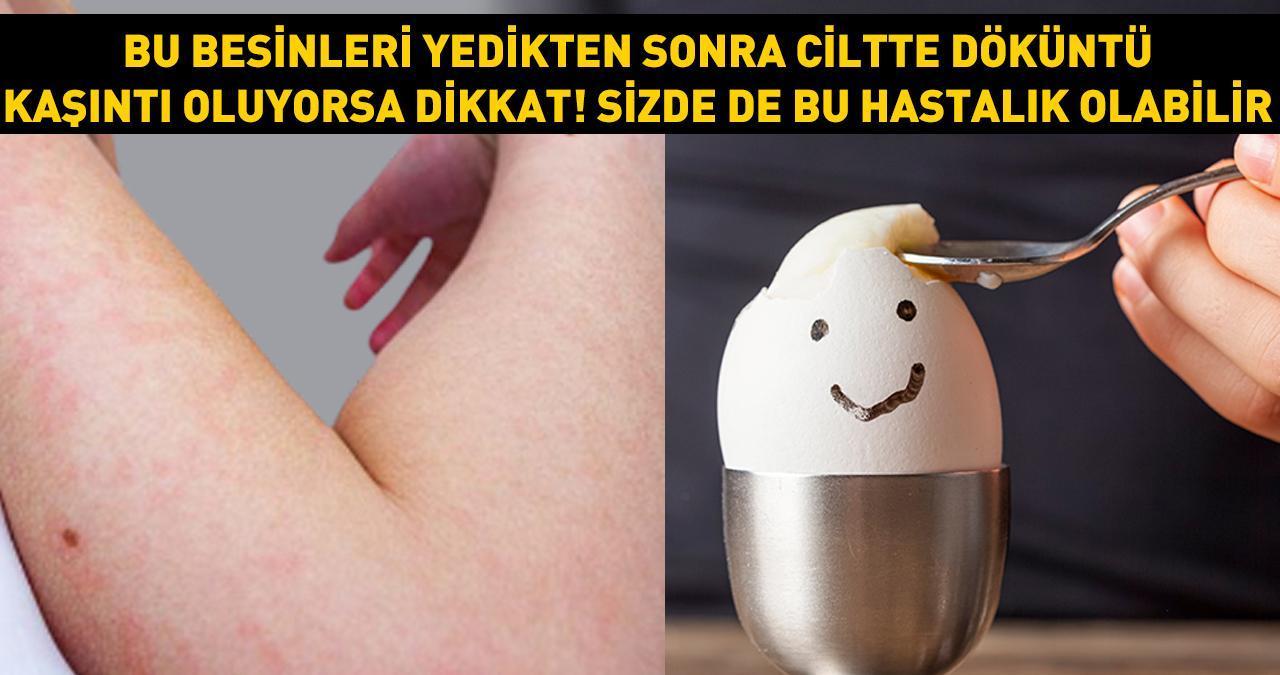 Bu besinleri yedikten sonra ciltte döküntü, kaşıntı varsa aman dikkat! Sizde de bu hastalık olabilir... Bazen belirti vermiyor