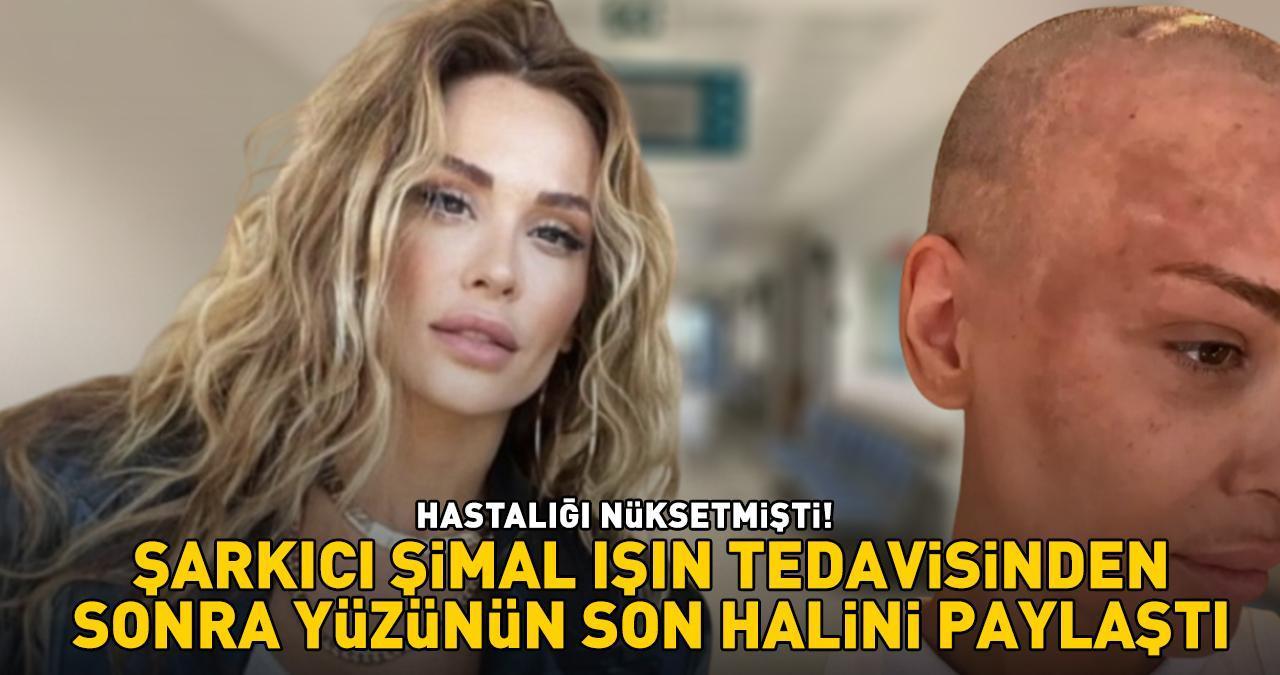 Şimal ışın tedavisinin ardından yüzünün son halini paylaştı: 'BUNA DA ŞÜKÜR!'