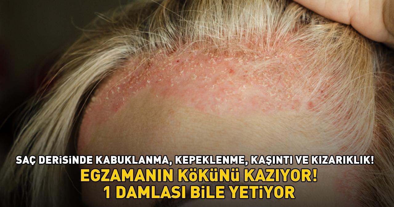 EGZAMANIN KÖKÜNÜ KAZIYOR! Saç derisinde kabuklanma, kepeklenme, kaşıntı ve kızarıklık! '1 damlası bile yetiyor'