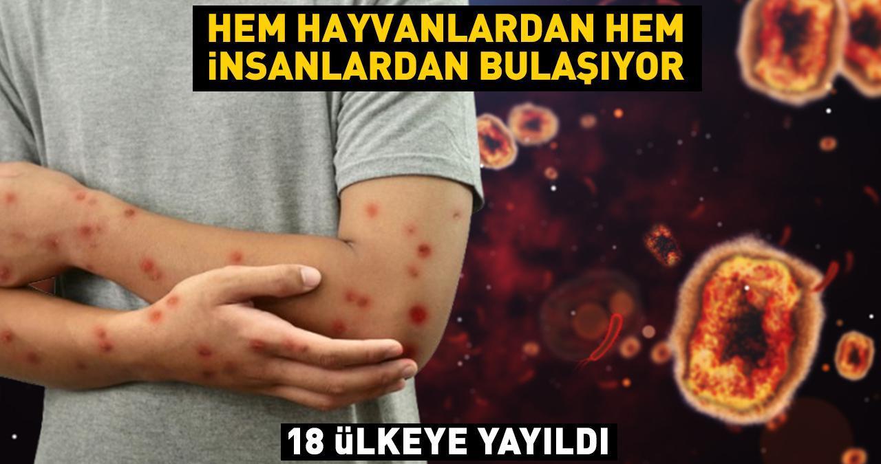 18 ülkeye yayıldı! Hem hayvanlardan hem insanlardan bulaşıyor