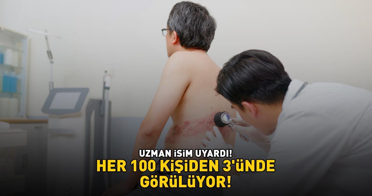 HER 100 KİŞİDEN 3'ÜNDE GÖRÜLÜYOR! Uzman isim uyardı: '85 yaşına kadar hastalığa yakalanma riski yüzde 50’