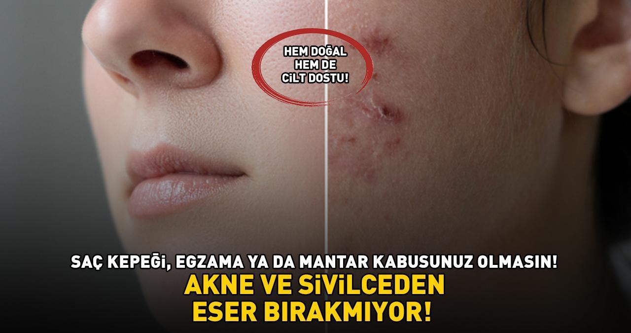 AKNE VE SİVİLCEDEN ESER BIRAKMIYOR! Kilosu 700, 1 tanesi 50 TL! Cilt dostu: Saç kepeği, egzama ile mantar kabusunuz olmasın!