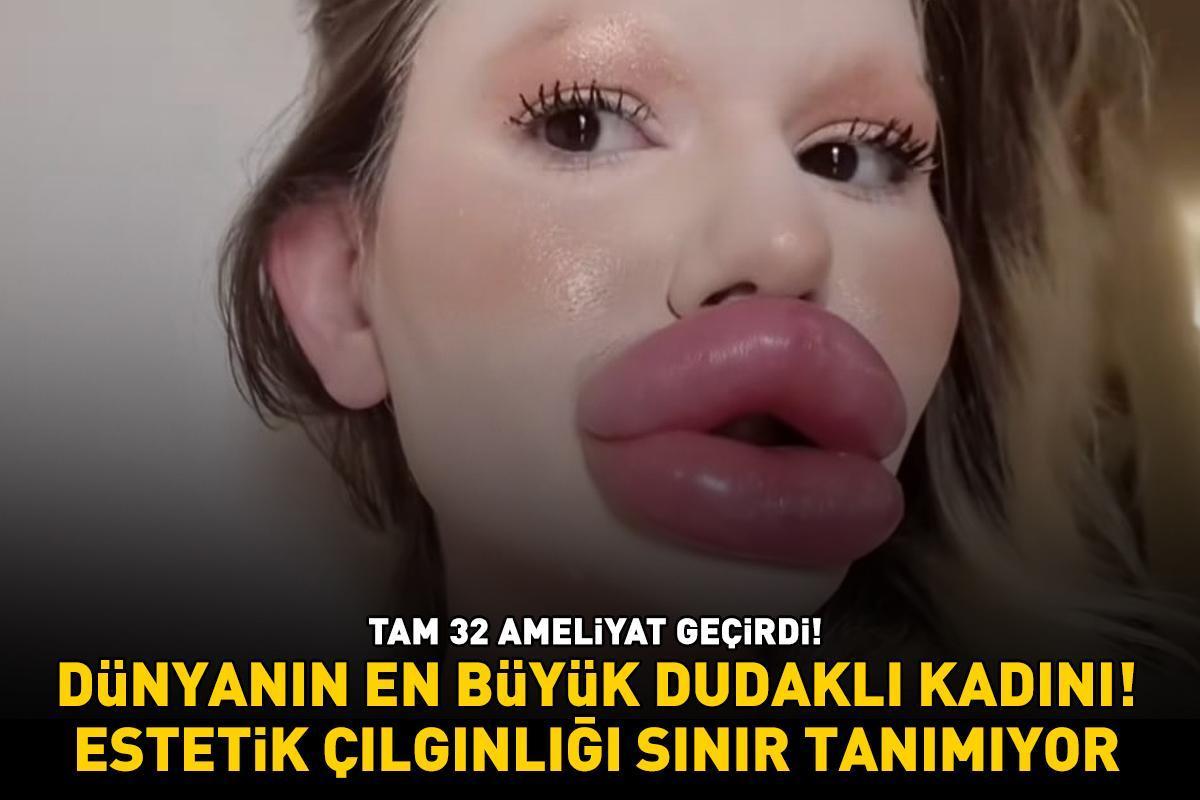 Dünyanın en büyük dudaklı kadını! Tam 32 ameliyat geçirdi! Uzmanlar uyarıyor: 'Estetik çılgınlığı sınır tanımıyor!'