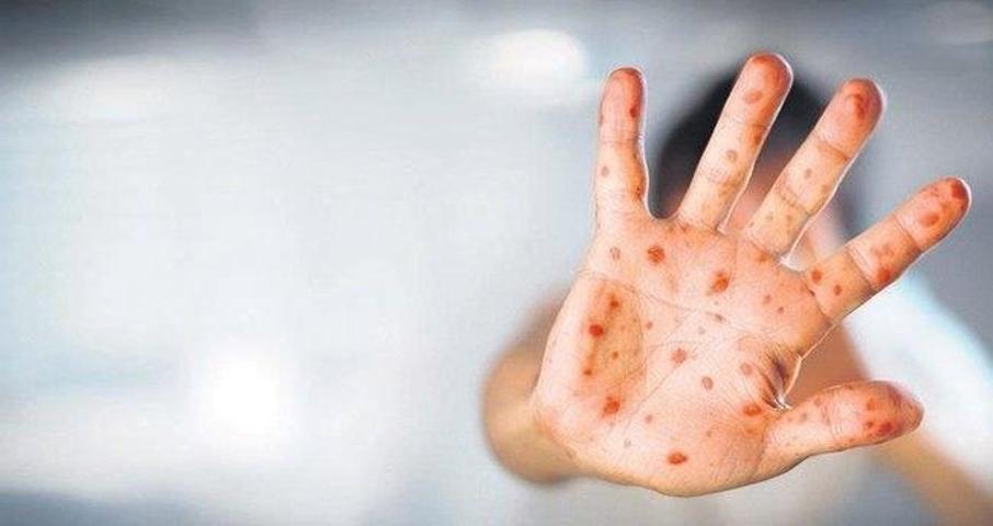 Maymun çiçeği virüsü bir ülkede daha görüldü
