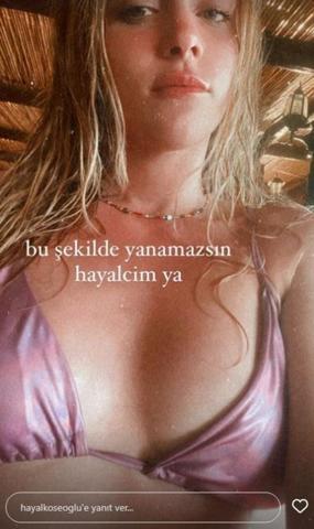 Hayal Köseoğlu tatilde fazla yandı