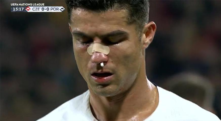 Çekya-Portekiz maçında Cristiano Ronaldo kanlar içinde kaldı