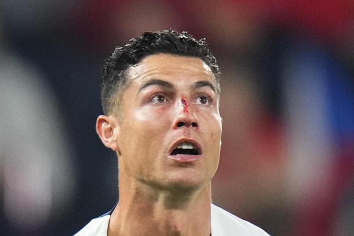 Çekya-Portekiz maçında Cristiano Ronaldo kanlar içinde kaldı