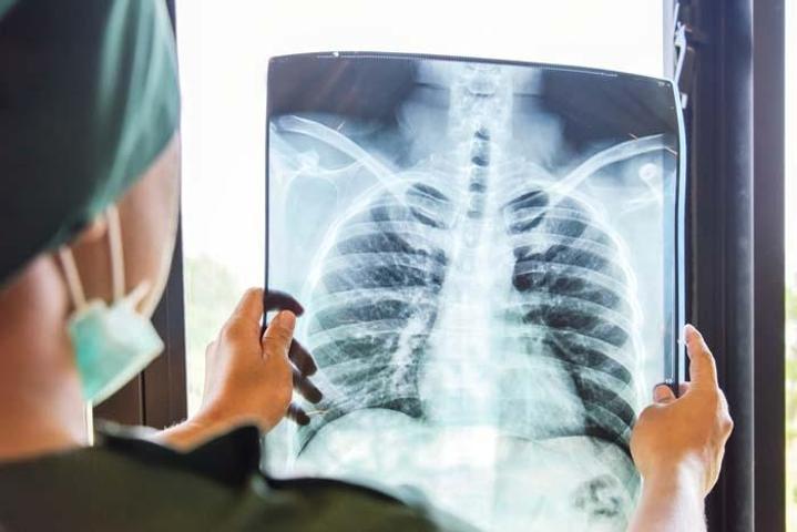 Prof. Dr. Özlü: Gizli tüberküloz arttı