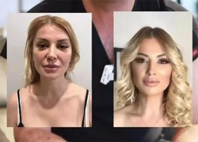 Songül Karlı estetiğe doymuyor