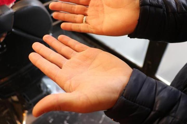 4 kuaförden 1inde bu hastalık var Saç boyası, saç açıcı, şampuanlar... Hepsi tetikliyor Tehlikenin adı...