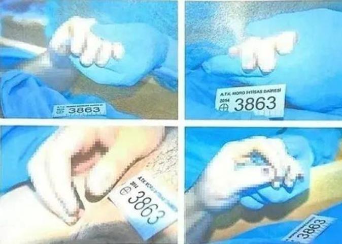 SON DAKİKA Cem Garipoğlunun otopsi fotoğrafında dikkat çekmişti Mor lekenin sırrı ne