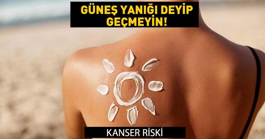 Güneş yanığı deyip geçmeyin Kanseri riski... Güneş yanığına ne iyi gelir