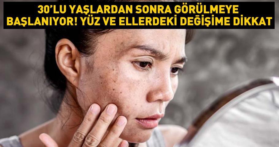30lu yaşlardan sonra görülmeye başlanıyor Yüz ve ellerdeki bu değişime dikkat