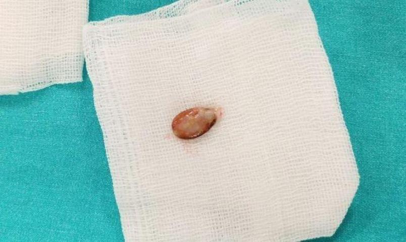 Doktorlar şaştı kaldı  3 yıl boyunca zatürre ve astım tedavisi gördü Meğer sebebi karpuz çekirdeğiymiş