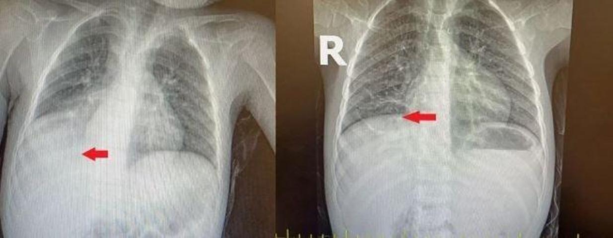 Doktorlar şaştı kaldı  3 yıl boyunca zatürre ve astım tedavisi gördü Meğer sebebi karpuz çekirdeğiymiş