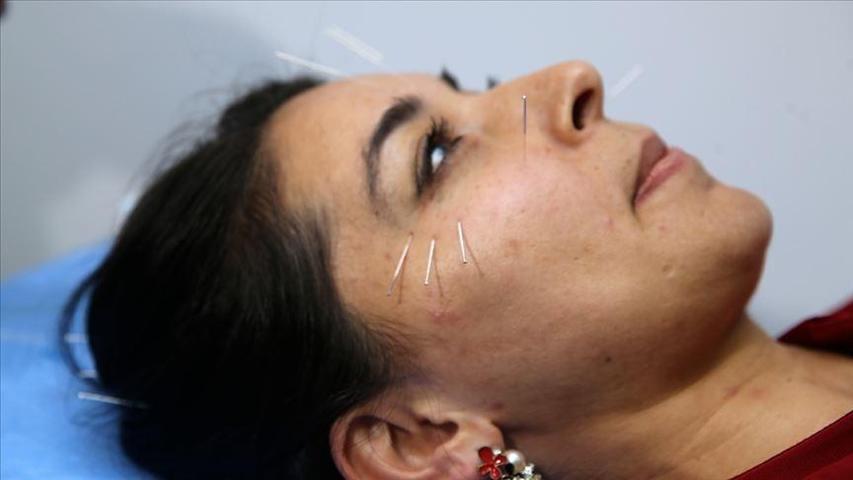 Binlerce Yıllık İğnelerin Şifa Geleneği: Asırlar Önce Bulundu, Hâlâ Kullanılıyor İbn-i Sinanın İzlerini Taşıyor…