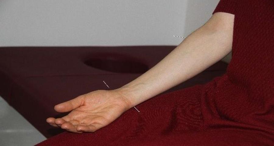 Binlerce Yıllık İğnelerin Şifa Geleneği: Asırlar Önce Bulundu, Hâlâ Kullanılıyor İbn-i Sinanın İzlerini Taşıyor…
