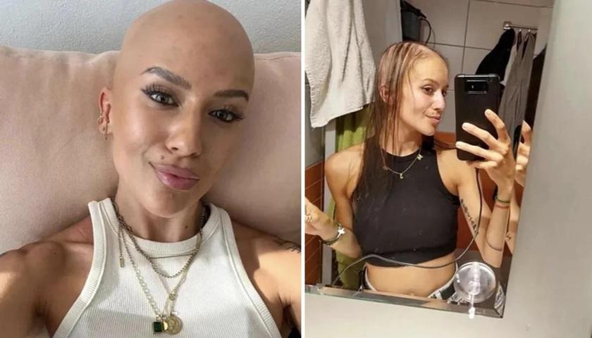 Güzelleşmek için bıçak altına yattı, ameliyat sonrası kabusu yaşadı Saç, kaş ve kirpiklerini kaybetmesinin sebebi bakın ne çıktı