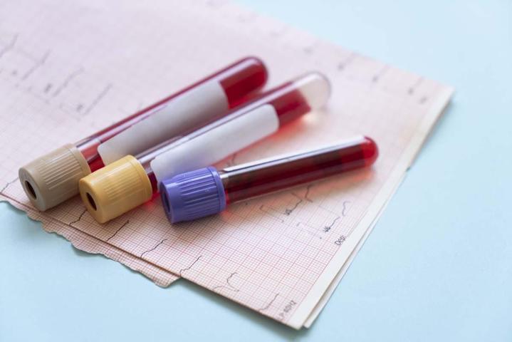 KAN TESTİ İLE TESPİT EDİLEN HASTALIKLAR: Kansızlık, Demir ve B12 Eksikliği, Pıhtı Atması... Basit Bir Kan Sayımı İle Bu Hastalıkları Teşhis Etmek Mümkün