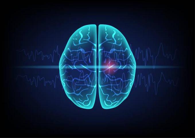 Ciddi kafa travmaları epilepsiye neden olabilir