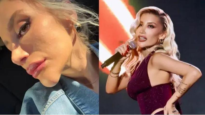 İrem Derici’nin çenesindeki şişlik gündem oldu Dolgu sanıldı, gerçek ortaya çıktı