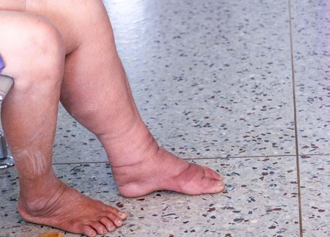 OBEZİTE SANILIYOR AMA DEĞİL Diyet Yapıyor Ama Bacaklarınız Ve Basen Bölgeniz İncelmiyorsa Dikkat Nedeni Bambaşka Olabilir