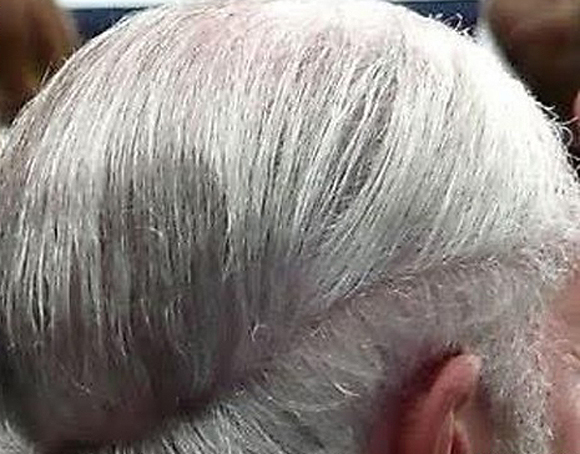 En başarısız kel kapatma yöntemleri