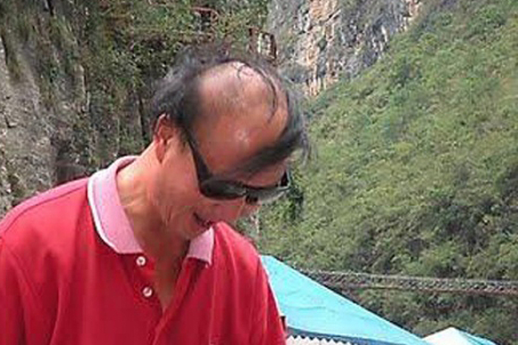 En başarısız kel kapatma yöntemleri
