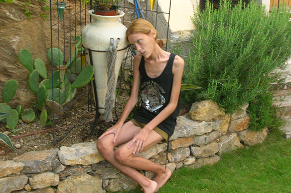 Model Isabelle Caro anoreksiyaya yenildi