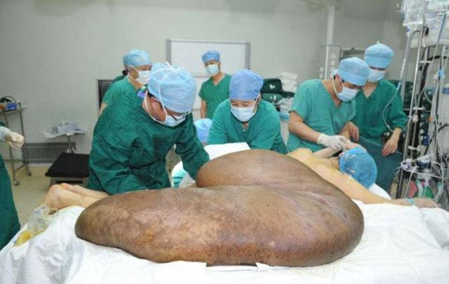 Vücudundan 110 kiloluk tümör çıkarıldı