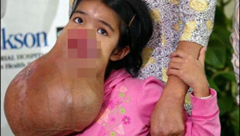 Tümörlü insanların ameliyat sonrası değişimi
