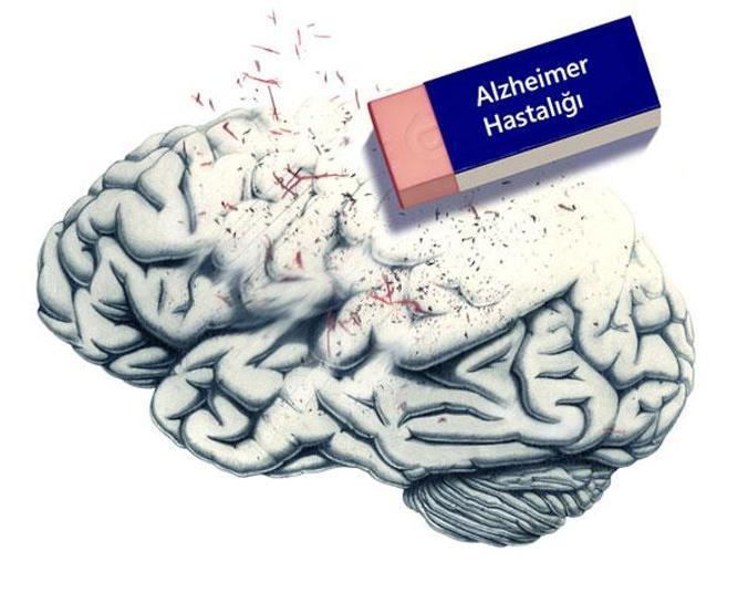 5 soruyla alzheimer testi
