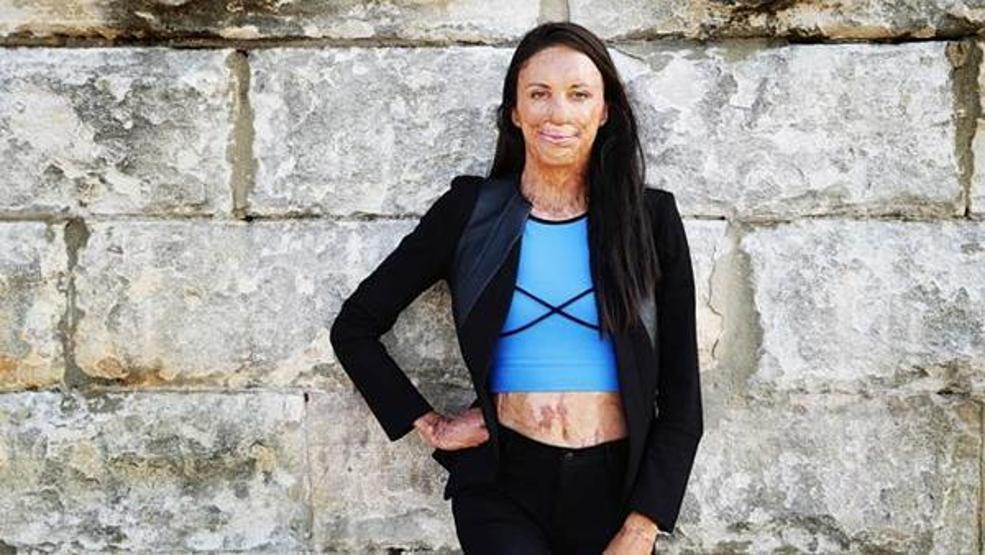 Turia Pitt ve sevgilisi Michael Hoskin nişanlandı
