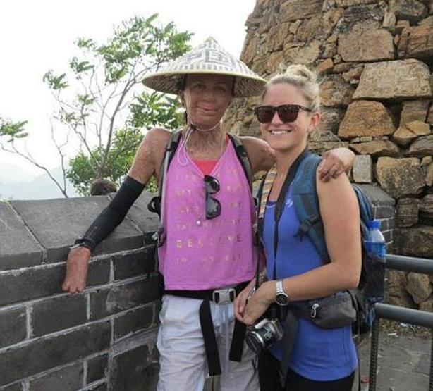 Turia Pitt ve sevgilisi Michael Hoskin nişanlandı