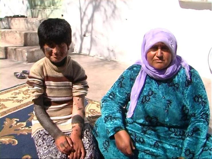10 yaşındaki kızın durumu yürek burkuyor
