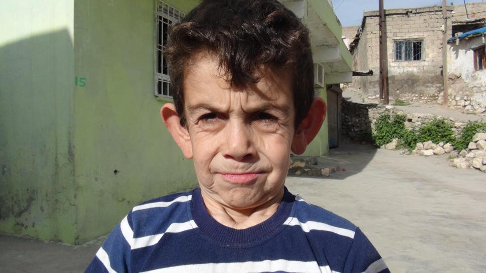 Erken yaşlanma hastalığına yakalandı