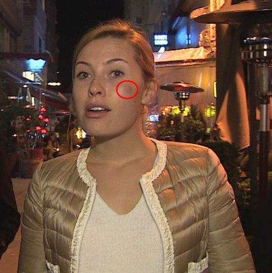 Chloe Loughnan: Yüzüme kapı çarptı