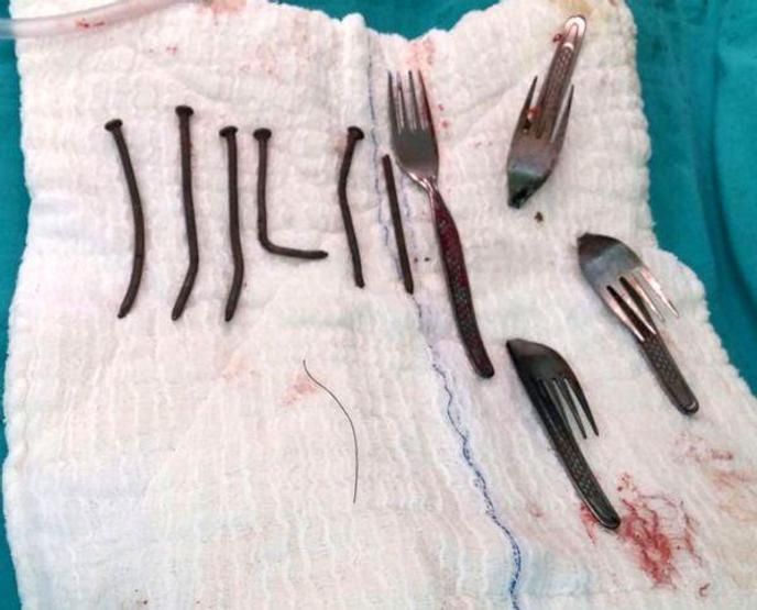 Midesinde 6 çivi, 4 çatal çıkarıldı