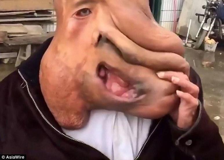 Milyarda bir görülen vaka: Fil adam