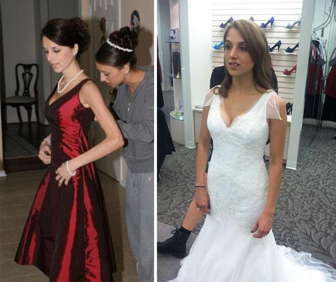 Anoreksiyadan kurtulan insanların inanılmaz değişimi