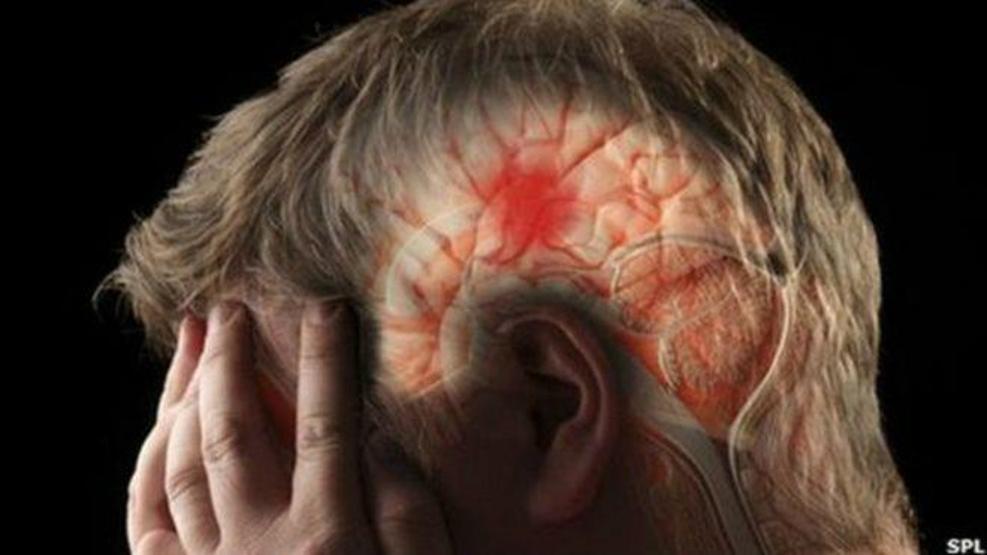 Türkiyede her yıl 40 bin kişi inme nedeniyle yaşamını yitiriyor