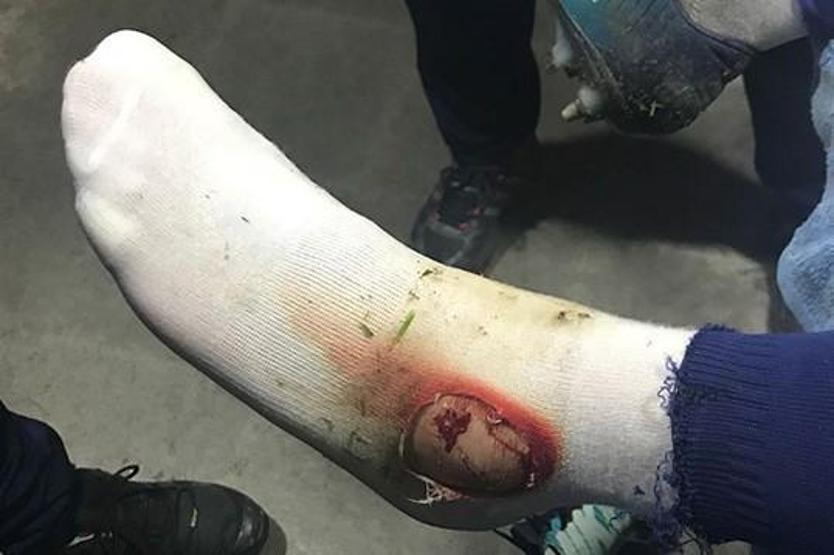 Fenerbahçe Hasan Ali Kaldırım’ın ayağının fotoğrafını paylaştı
