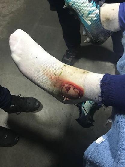 Fenerbahçe Hasan Ali Kaldırım’ın ayağının fotoğrafını paylaştı