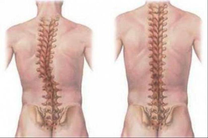 Uzmanlardan skolyoz uyarısı: Hepsi ameliyat gerektirmiyor
