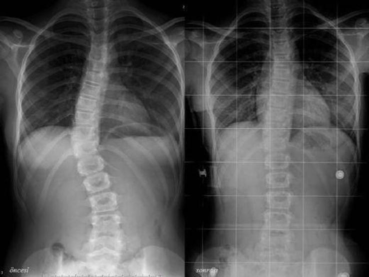 Uzmanlardan skolyoz uyarısı: Hepsi ameliyat gerektirmiyor