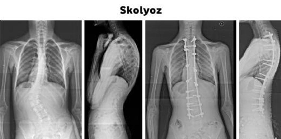 Uzmanlardan skolyoz uyarısı: Hepsi ameliyat gerektirmiyor